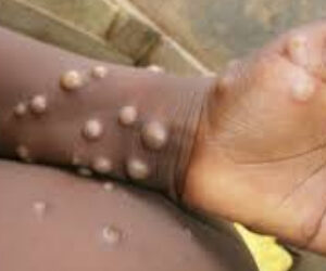 Morocco: First Mpox case reported in Marrakech, health authorities activate emergency protocols